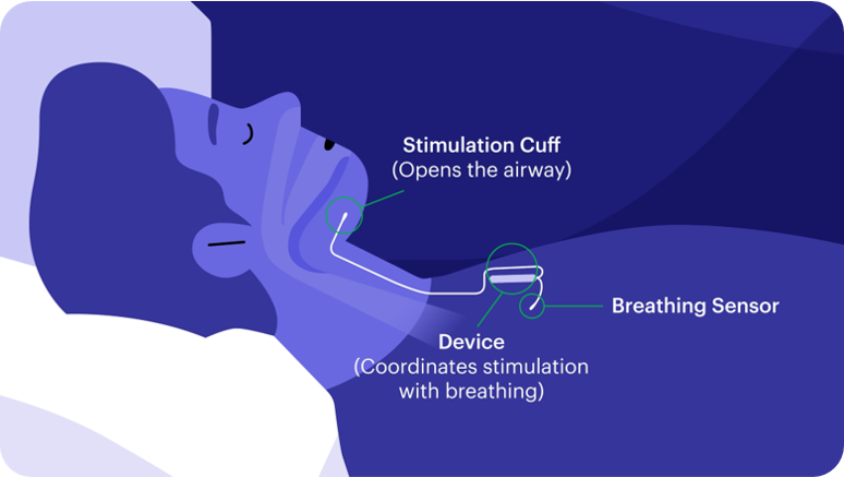 Diagram of the Inspire sleep apnea device showing the stimulation cuff and breathing sensor